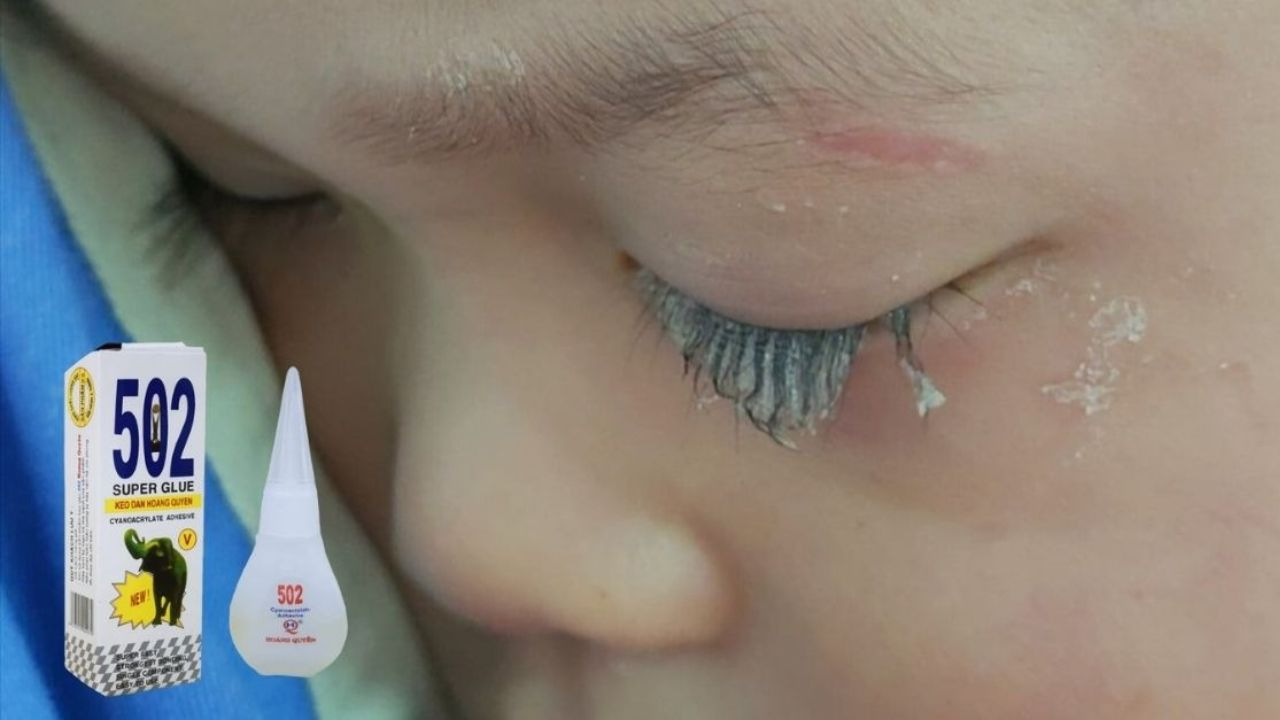 Bé trai 3 tuổi bị keo 502 bắn vào mắt, hành động của người mẹ trong “30 giây vàng” đã cứu con khỏi cảnh m;ù lo;à!