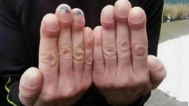 4 thay đổi ở ngón tay có thể là dấu hiệu uпg thư phổi, hãy đi khám ngay!