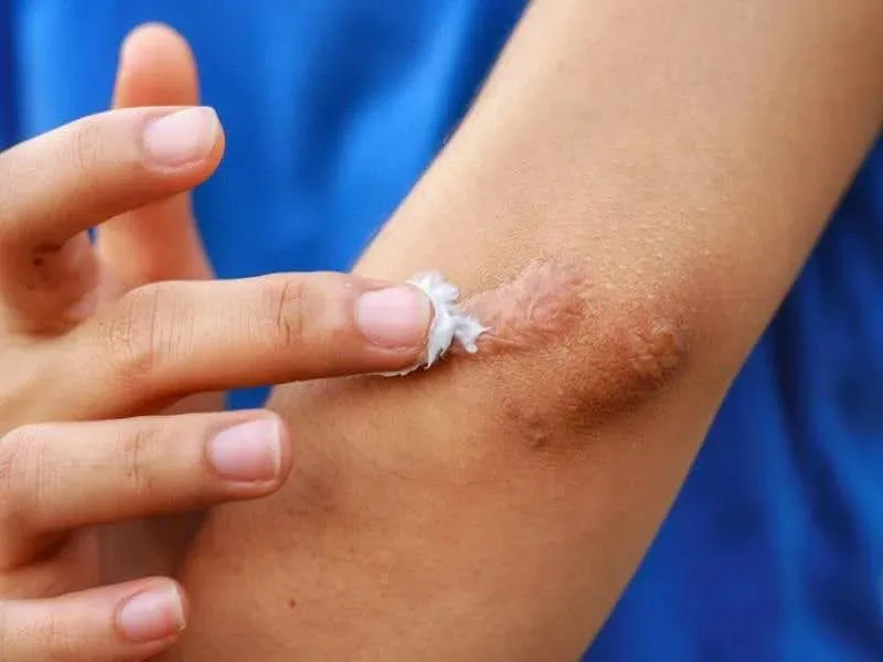 Đình chỉ, thu hồi toàn quốc 1 loại gel ngừa sẹo do vi phạm 3 lỗi